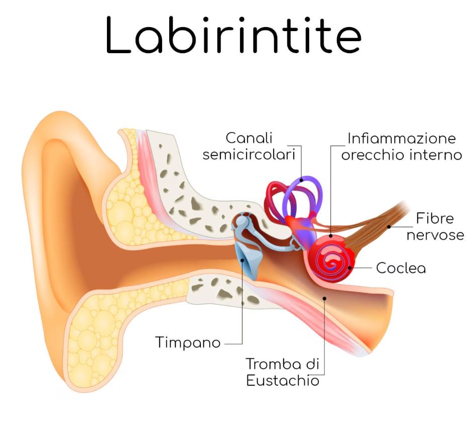 Labirintite