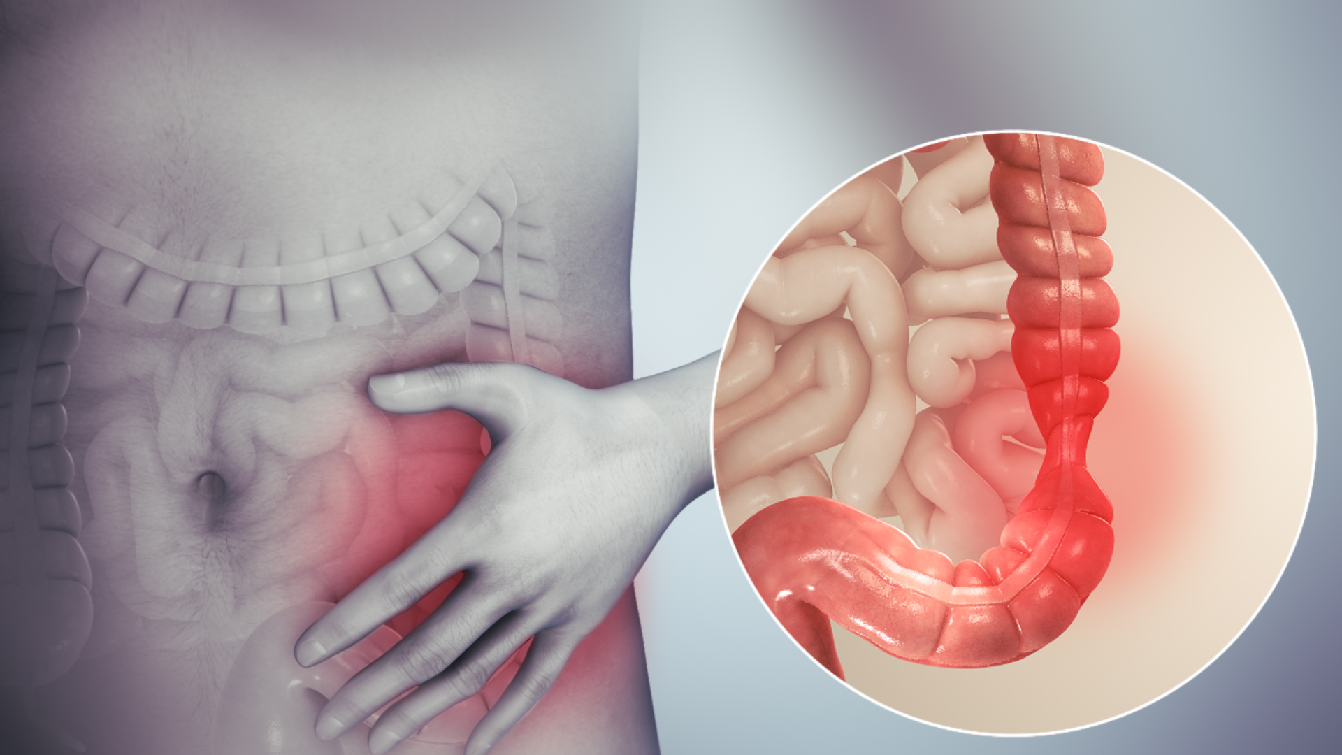 Intestino infiammato